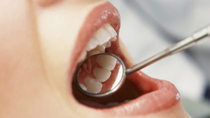 Check ups | Teeth Diagnosis & Prevention | Dental Plus Tauranga