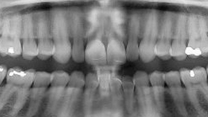 Digital X-Rays | Teeth Diagnosis & Prevention | Dental Plus Tauranga