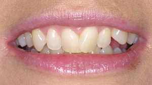 Six Month Braces, Orthodontics, DentalPlus Tauranga