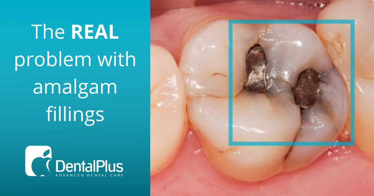 What is Amalgam Filling?