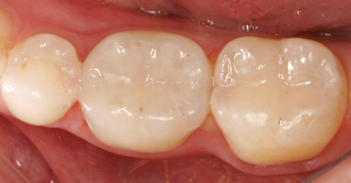 Read more about the article UltraTough fillings at DentalPlus